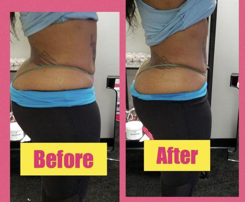 Lipo Cavitation and Lipo Laser. Both procedures are painless with no downtime.