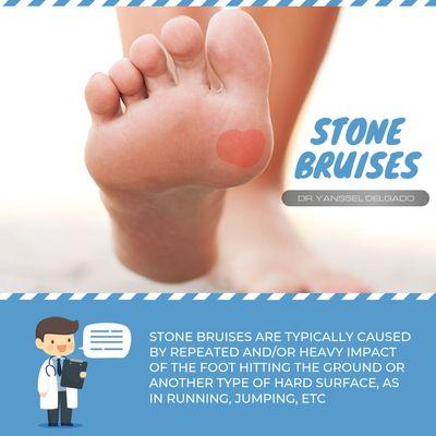 A stone bruise is a deep bruise of the fat pad of the heel or ball of the foot. It's often from an impact injury.