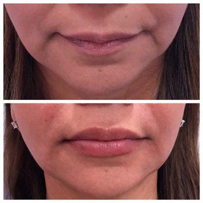 The power of Juvaderm!Gave the patient a more even lip line and shape! Volume was enhanced but still keeping her lips natural.