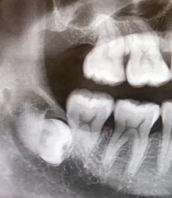 Impacted wisdom tooth