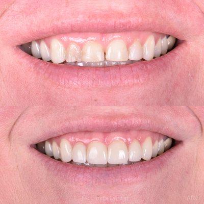 This patient saw several dentists for bondings which always chipped. We restored her front 4 teeth with crowns. No more chipping.