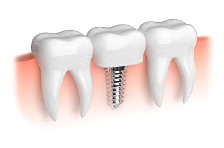 Dental implants