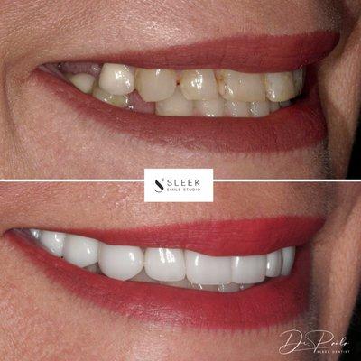 Rejuvenated smile with porcelain crowns and veneers combo