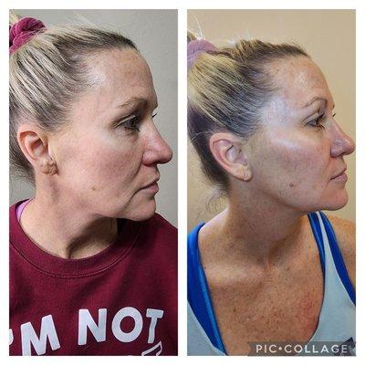 Rf skin tightening session