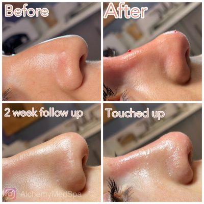 Liquid nose augmentation journey