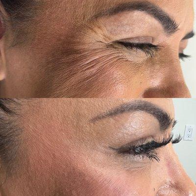 Before and after Botox treatments for around the eyes wrinkles