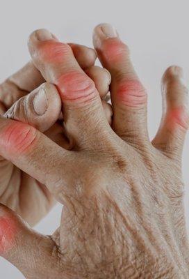 Rheumatoid, psoriastic & osteoarthritis