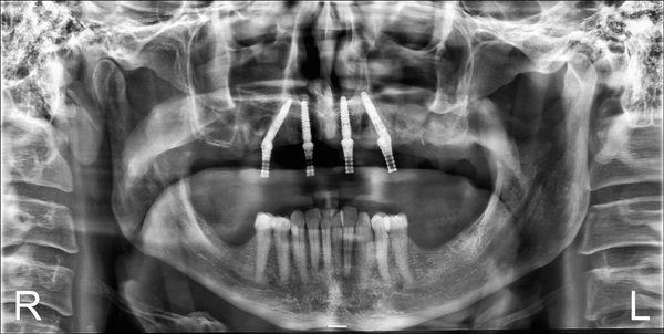 X-ray of an upper all on 4 surgery