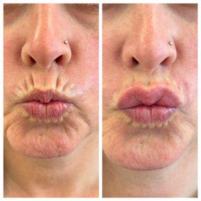 Filled in this lovely ladies lip lines and gave a little hydration to her upper lip.