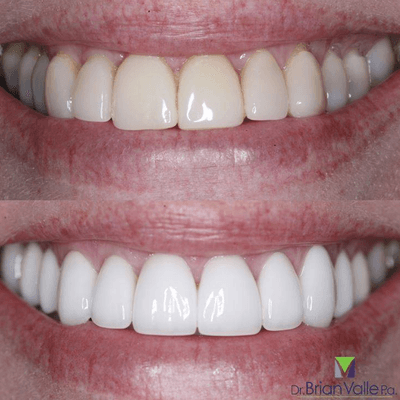 We love the results!  Look what new Porcelain veneers did for this beautiful smile.