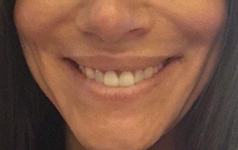 Before. Veneers from 2001 on central teeth after bonding. One of the few pictures I have with teeth.