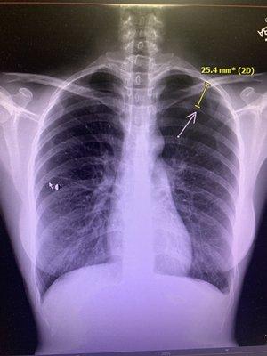 Dr Guo made my left lung collapse--pneumothorax