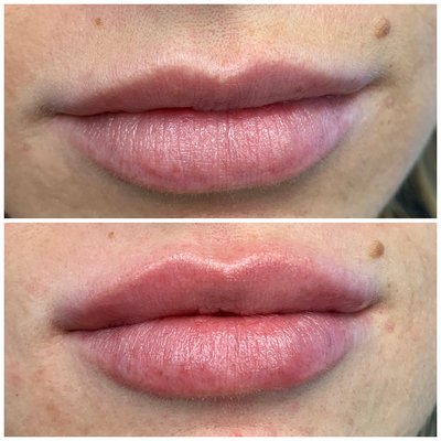 Before and after lip filler