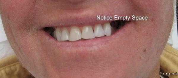 New implants with crowns.