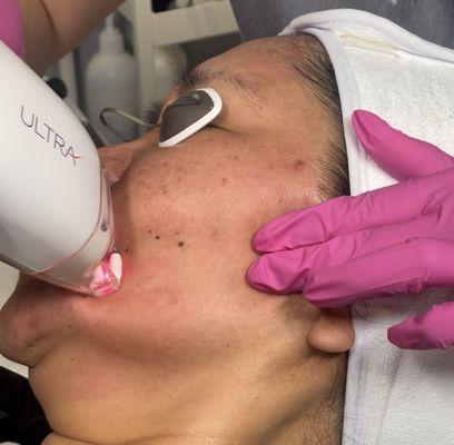 Laser skin resurfacing safe for ALL skin types