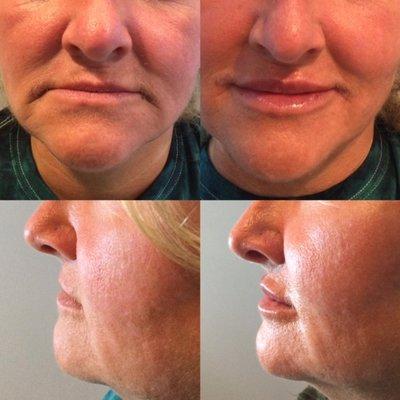 Dermal Fillers Treatment