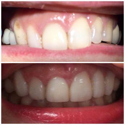 6unit veneers