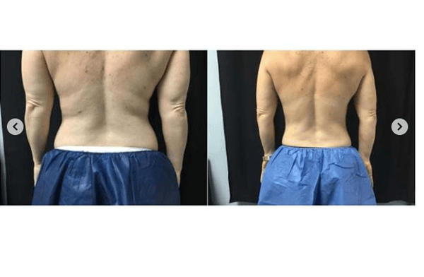 CoolSculpting