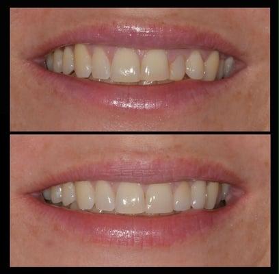 This smile makeover was very conservative. The patient had bonding on one tooth and two crowns, along with a small procedure on her gums.