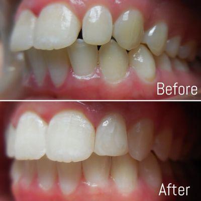 Invisalign - spacing - before / after