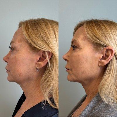 Dermal Filler to chin, cheeks, jawline