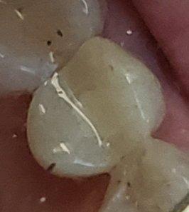 Crown placed over the implant! Full chewing function and esthetics restored!