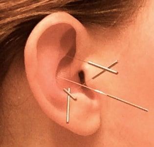 Auricular Acupuncture