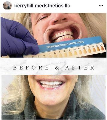 Before and After Laser Teeth Whitening