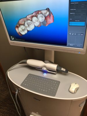 IiTero digital scanner - no more uncomfortable mouth impressions