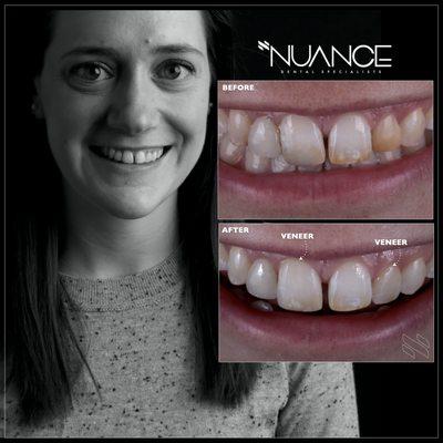 Natural porcelain veneers have a stunning chameleon effect in a smile.