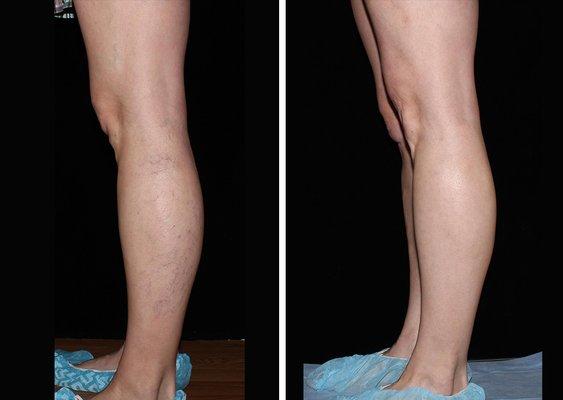 Before & After spider vein treatment