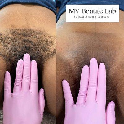 Brazilian sugaring