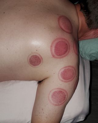 Cupping