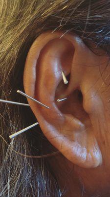 Auricular acupuncture for shoulder pain