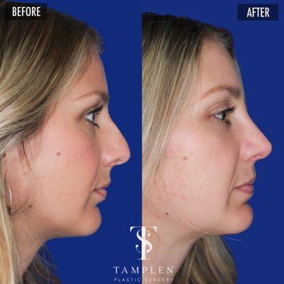 Beautiful result 6 months after Rhinoplasty!