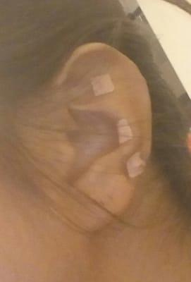 Acu-magnets on my left ear.  The fourth magnet is on the back, located just above the one on the bottom front.