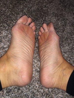 Results from an awful pedicure on 9/2/2021