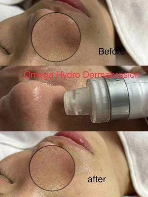 Hydra facial