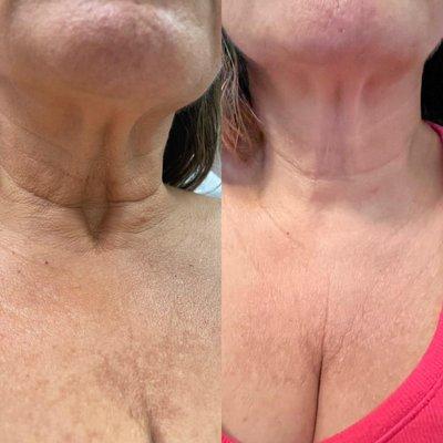 Radiesse to reduce appearance of neck lines. One month results.