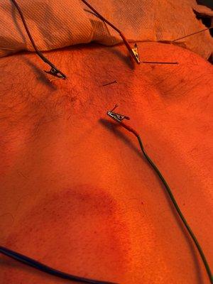 Electric-Acupuncture