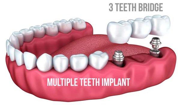 Three Unit Implant Bridge