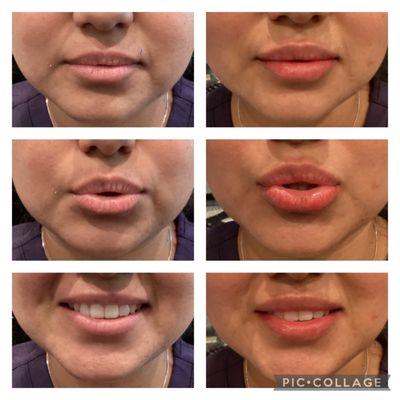 Lip filler