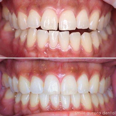 Invisalign (7 months treatment)