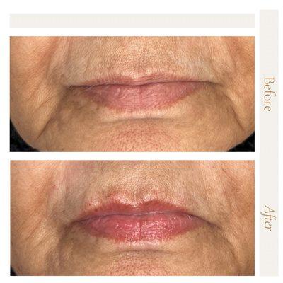 Lip filler, Revance product