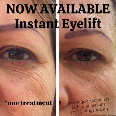 Instant Eyelift pre &post one treatment.  This service works best in a series of 4