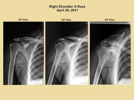 Right Shoulder X-Rays for expert testimony