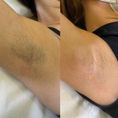 Before and after laser hair removal on the underarms