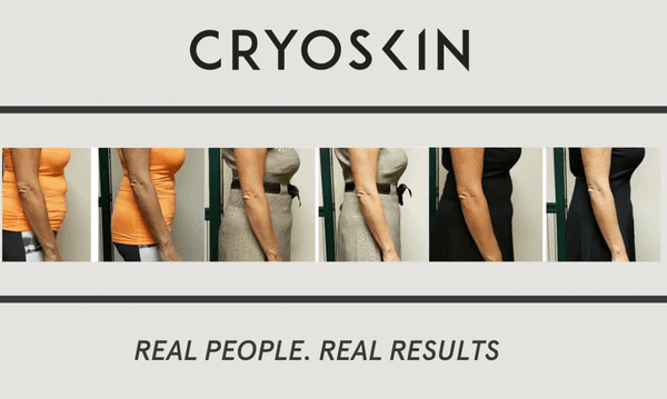 Cryoskin