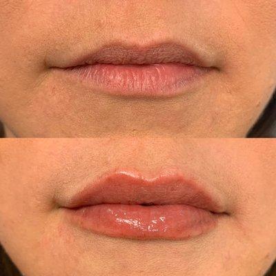 Lips injected by Dr. Nely Aldrich