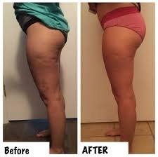 We can smooth cellulite!